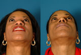 African American Nose Surgery