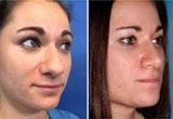 Big Nose Surgery