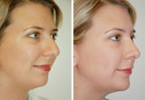 Nose Surgery Belfast