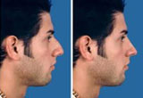 Nose Surgery Cardiff