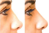 Nose Surgery Essex