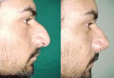 Nose Surgery Sheffield